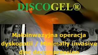 DISCOGEL® MAŁOINWAZYJNE PRZEZSKÓRNE LECZENIE DYSKPATII [upl. by Manbahs965]