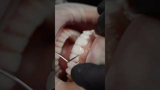 “Veneers transforms smiles creating confident happy patients” dentist dental viralvideo [upl. by Asihtal239]