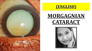 What is a Morgagnian Cataract  Ophthalmology [upl. by Fredia]