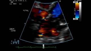 Atrial Septal Defect  Ostium Secundum Type  TTE [upl. by Ellecrad]