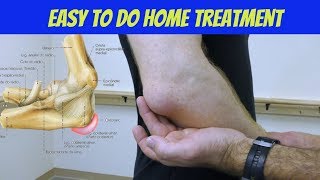 Elbow Bursitis Treatment at Home  How to Treat Olecranon Bursitis [upl. by Anileda]