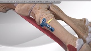 LowProfile Proximal Opening Wedge Osteotomy Using a Locking Plate [upl. by Lierbag]