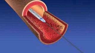 Balloon Angioplasty and Stent Implantaion [upl. by Aerdnna311]