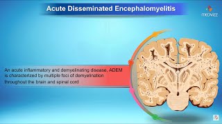 Acute disseminated encephalomyelitis  Neurology [upl. by Jr]