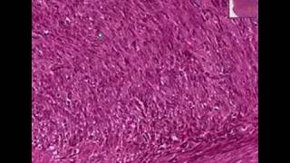 Histopathology Soft tissueFibrosarcoma [upl. by Diannne406]