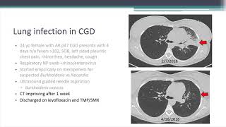 Lung InflammationGranuloma Problems with CGD [upl. by Ikkim]