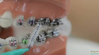 How to use interdental brushes on braces  Evolution Orthodontics [upl. by Dorinda]