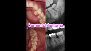 Cementoblastoma Definition Causes Sign And Symptoms Treatment and Prevention [upl. by Ettore28]