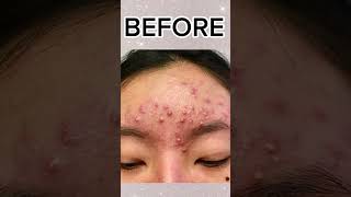 Accutane Acne Treatment by Dr Shafa dermatology dermatologist acne accutane youtubeshorts [upl. by Ragen758]