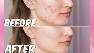 Pimples को जड़ से खत्म करें  How To Remove Pimples in 7 Days  Pimple Kaise Hataye [upl. by Ajiat]