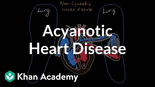 What is acyanotic heart disease  Circulatory System and Disease  NCLEXRN  Khan Academy [upl. by Rolo]