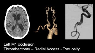 Stroke  Left M1 occlusion Radial  Tortuous 1x [upl. by Eerehc]