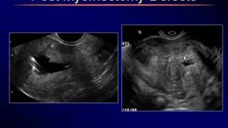 Sonography of Uterine Myometrial Disorders [upl. by Ainitsirhc]