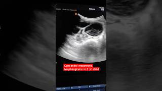 Congenital mesenteric lymphangioma in a 3 yr boy which was herniating into the right scrotal sac [upl. by Arodoet]