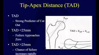 Proximal Femur Fractures 4 Intertrochanteric Hip Fractures [upl. by Ruelu508]