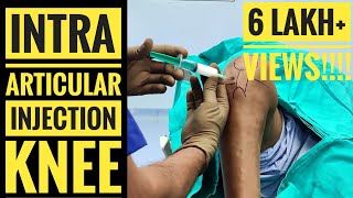 Painfree Intraarticular Injection of Knee [upl. by Airalav388]