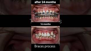 braces process after 24 months braces transformation braces orthodontist dentist shorts viral [upl. by Ozen528]