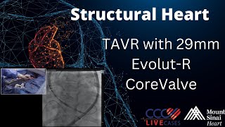 TAVR with 29mm EvolutR CoreValve  Structural Heart Sept 2017 [upl. by Ackler]