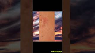 13 TIK TOK PIMPLE VIDEO COMPILATION US UK  22nd August 2020 [upl. by Halima]