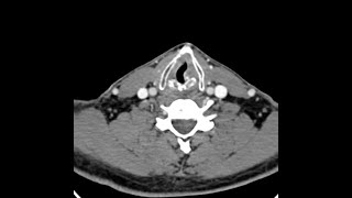 Teaching Rounds Locally Advanced Inoperable Oral Cancer [upl. by Aisiram]