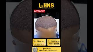 Hair Transplant இப்படி தான் பண்றங்களா  Best Hair Transplant in Coimbatore  La HNS Coimbatore [upl. by Clougher]