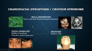 Brief discussion on Crouzon syndrome [upl. by Inirt830]