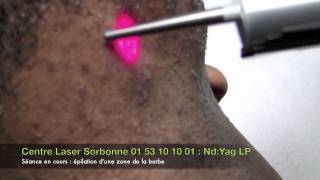 Epilation laser Paris phototype foncé LaserSorbonne [upl. by Crista]