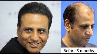 Hair Transplant Clinic in Mumbai at Eugenix Hair Sciences India [upl. by Srednas]