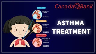 Asthma Treatment [upl. by Dylane]