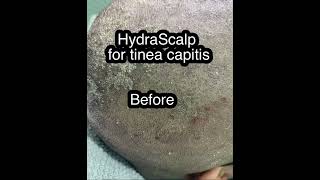 HydraScalp for tinea capitisseborrheic dermatitis [upl. by Mastat]