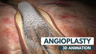 Angioplasty  3D Animation  Real Footage [upl. by Houlberg564]