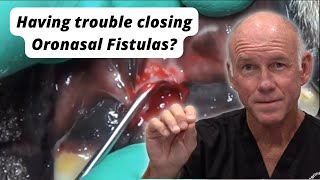 Having trouble closing Oronasal Fistulas [upl. by Farland]