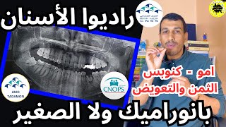 راديو بانوراميك PANORAMIQUE راديو صغير تغليف الاسنان قتيل العرق فيكس كنوبس سنيسيس امو CNOPS AMO CNSS [upl. by Ela248]