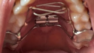 Braces Vlog Palatal Expander  Tongue Crib ChroniclesUpdate [upl. by Inoj]