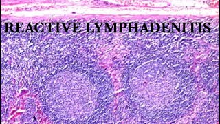 WHAT IS REACTIVE LYMPHADENITIS [upl. by Campagna]