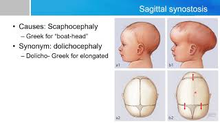 Neurosurgery written board crash course  craniosynostosis part1 [upl. by Haldeman]