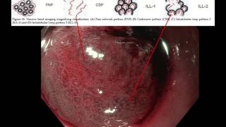 Imaging of a poorly differentiated adenocarcinoma of the stomach with signet ring cells [upl. by Noiz]