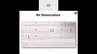 Wide Complex Tachyarrhythmias Part 2 Morphological Differences amp Identifying Factors [upl. by Au653]