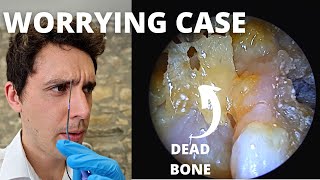 Dead Bone And Infection In Ear Cavity Mastoid Sequestrum And Granulation [upl. by Karee]