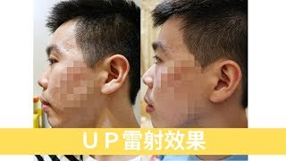 三重知名皮膚科治療！治療痘疤凹洞：UP雷射第一次效果 （下集） Bolow 菠蘿 [upl. by Amles]