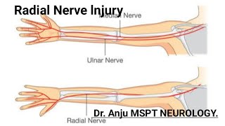 Radial nerve Injury Neuropathy Wrist Drop Hand Drop Causes Symptoms Diagnosis [upl. by Dorie]