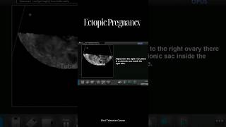 Ectopic Pregnancy [upl. by Lydie]