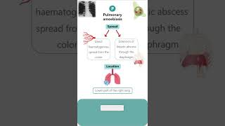 PULMONARY AMOEBIASIS parasitology microbiology pathology neet neetpg amoebiasis amoeba [upl. by Antin]