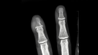 Osteomyelitis of the finger [upl. by Weatherby61]