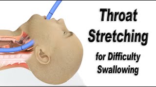 Esophageal Dilation or Throat Stretching for Difficulty Swallowing [upl. by Larkin698]