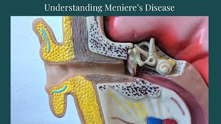 Menieres Disease Made Simple Explained by a Physical Therapist [upl. by Oaks]