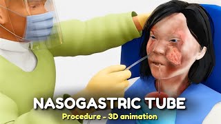 Nasogastric NG Tube Procedure  3D animation [upl. by Nilok283]