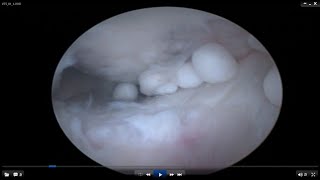 Loose Bodies in the Knee Joint A brief video [upl. by Borlow]