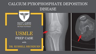 Calcium Pyrophosphate Deposition Disease [upl. by Sedda]