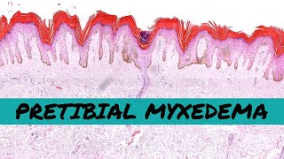 Pretibial Myxedema thyroid dermopathy of Graves disease hyperthyroidism [upl. by Camile]